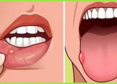 درمان زخم روی زبان